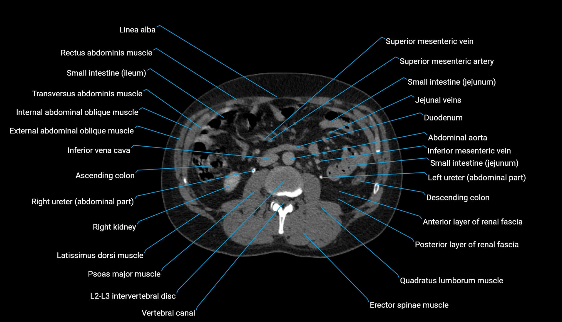 CT urogram axial cross sectional anatomy  labelled radiology image-00123.webp